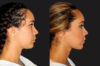 Submental Liposuction case #6943 slider thumbnail