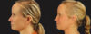 Profound RF Skin Tightening case #6906 slider thumbnail