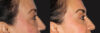 Blepharoplasty case #6888 slider thumbnail