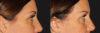 Blepharoplasty case #6890 slider thumbnail