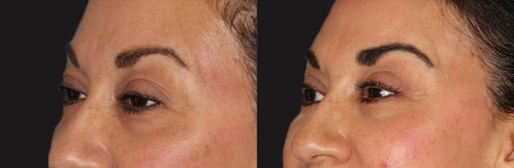 Blepharoplasty case #6888