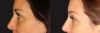 Blepharoplasty case #6890 slider thumbnail