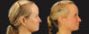 Profound RF Skin Tightening case #6906 slider thumbnail