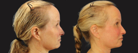 Profound RF Skin Tightening case #6906