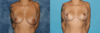 Breast Reduction case #7931 slider thumbnail