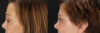 Blepharoplasty case #6889 slider thumbnail