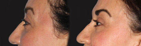 Blepharoplasty case #6888