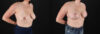 Breast Lift with Implants case #7897 slider thumbnail