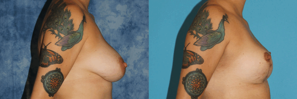 Breast Reduction case #7931