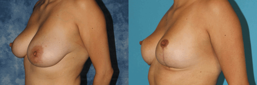 Breast Reduction case #7931