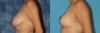 Breast Reduction case #7931 slider thumbnail
