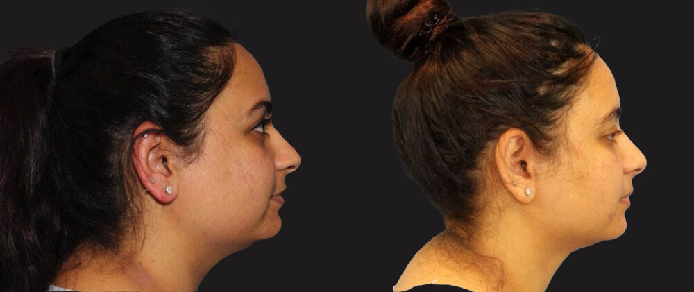 Submental Liposuction case #6946