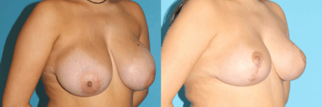 Breast Reduction case #7928