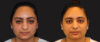 Submental Liposuction case #6946 slider thumbnail
