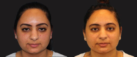 Submental Liposuction case #6946