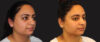 Submental Liposuction case #6946 slider thumbnail