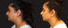 Submental Liposuction case #6946 slider thumbnail