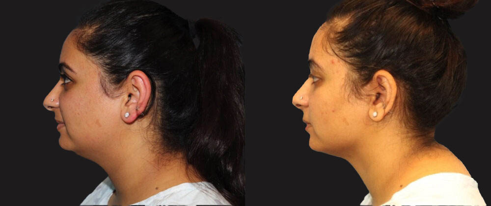 Submental Liposuction case #6946