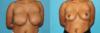 Breast Reduction case #7939 slider thumbnail