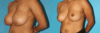 Breast Reduction case #7939 slider thumbnail