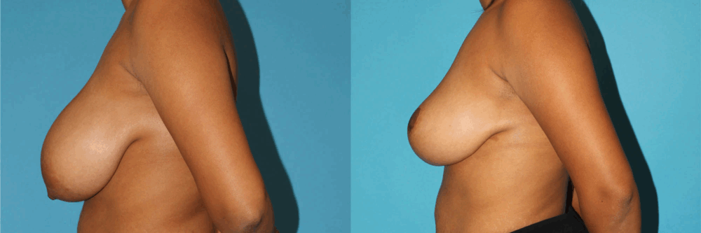 Breast Reduction case #7939