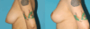 Breast Reduction case #7956 slider thumbnail