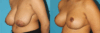 Breast Reduction case #7962 slider thumbnail