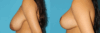 Breast Reduction case #7962 slider thumbnail
