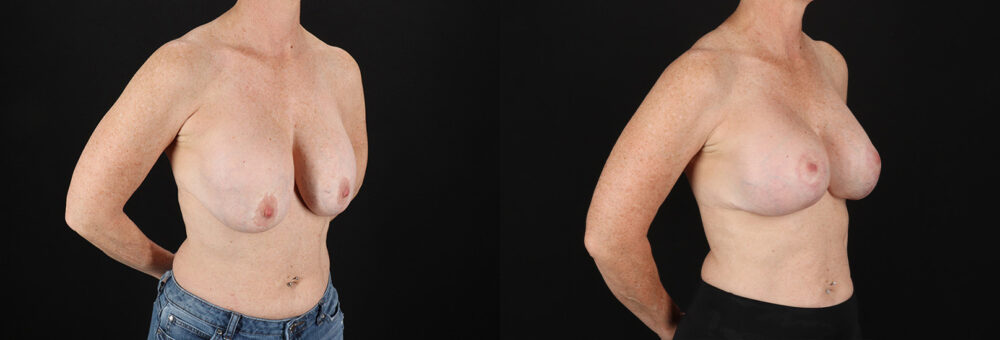 Revision Breast Surgery case #256267