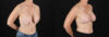 Revision Breast Surgery case #256267 slider thumbnail