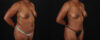 Mommy Makeover case #6688 slider thumbnail