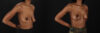 Breast Lift case #7806 slider thumbnail