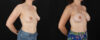 Breast Augmentation case #6491 slider thumbnail
