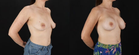 Breast Augmentation case #6491