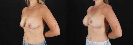 Breast Lift with Implants case #7903