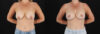 Breast Lift with Implants case #7903 slider thumbnail