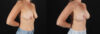 Breast Lift with Implants case #7903 slider thumbnail