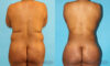 Brazilian Butt Lift case #4452 slider thumbnail
