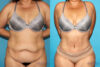 Tummy Tuck case #7226 slider thumbnail