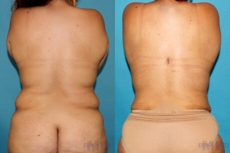 Tummy Tuck case #7226