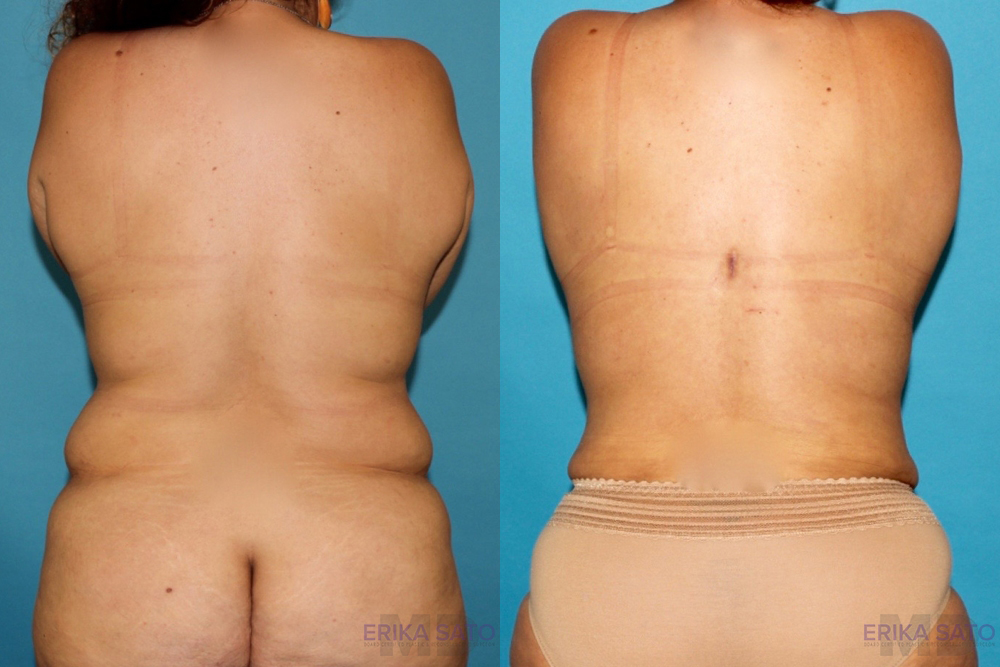Tummy Tuck case #7226