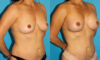Breast Augmentation case #5603 slider thumbnail
