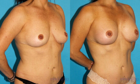 Breast Augmentation case #5603