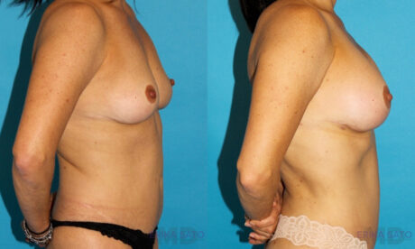 Breast Augmentation case #5603