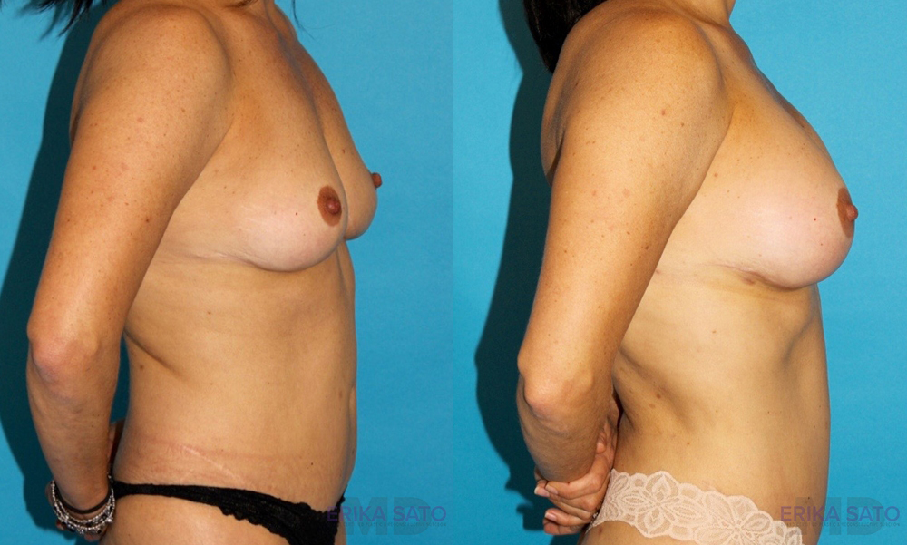 Breast Augmentation case #5603