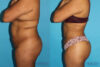 Brazilian Butt Lift case #4495 slider thumbnail
