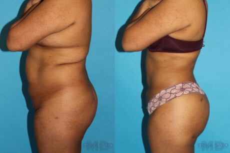 Brazilian Butt Lift case #4495