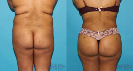 Brazilian Butt Lift case #4495