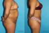 Brazilian Butt Lift case #4495 slider thumbnail