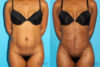 Brazilian Butt Lift case #4640 slider thumbnail